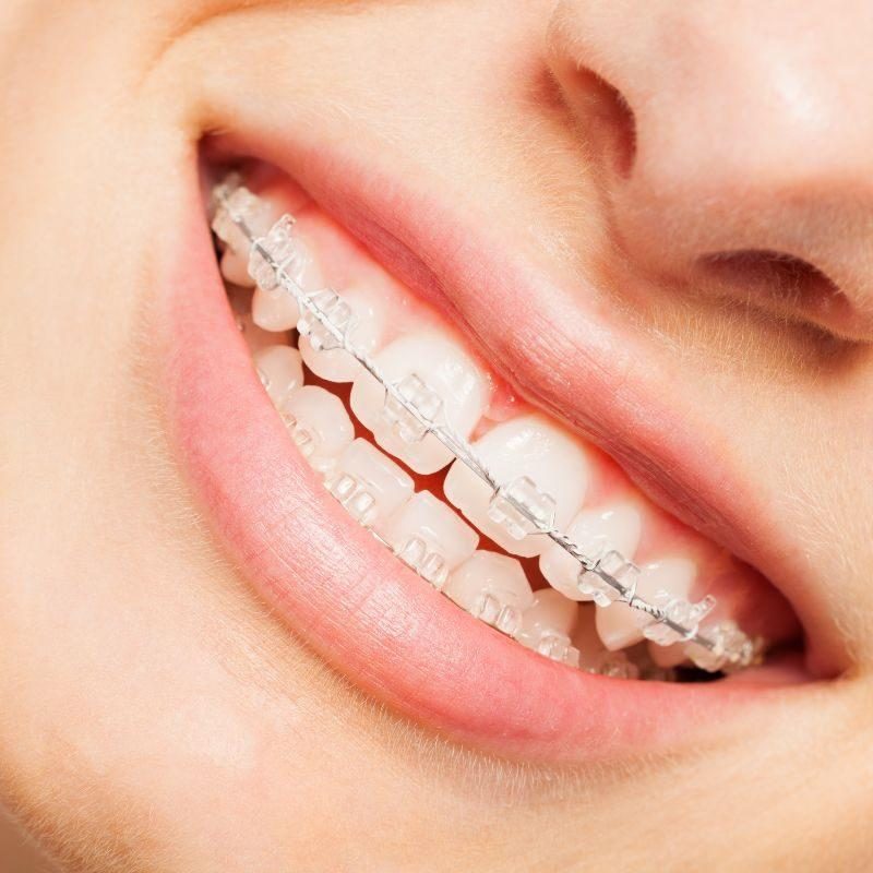 Clear ceramic braces
